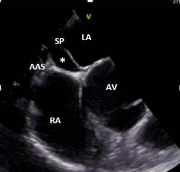 Transcatheter Closure of a Patent Foramen Ovale With a Small Adjacent Atrial Septal Defect and a Double Interatrial Septum Post Cryptogenic Stroke.