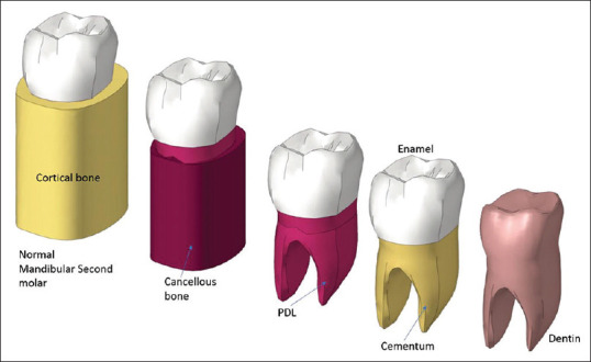 Effect of osseous defect on periodontal ligament stress under normal masticatory force: A three-dimensional finite element analysis of mandibular second molar.
