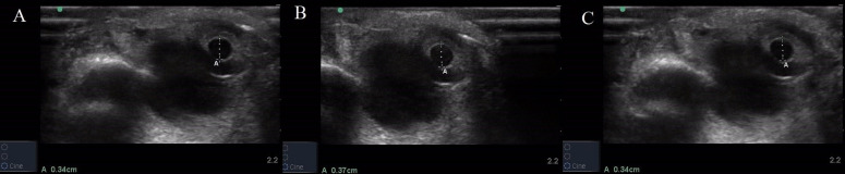 Correlation of Point of Care Ultrasound (POCUS) Guided Pupillary Assessment Parameter with Glasgow Coma Scale in Patients with Altered Mental Status- A Cross Sectional Study.