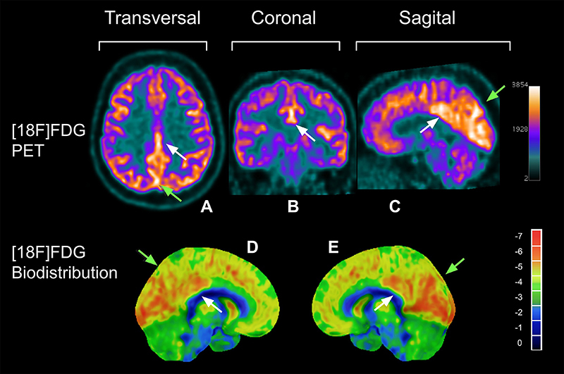 Changes in cerebral glucose metabolism among mild long COVID patients: an [18F]FDG PET/CT study.