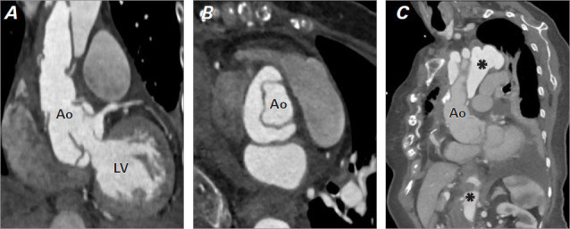 Transcatheter Aortic Valve Implantation Bailout for Severe Aortic Insufficiency due to Aortic Root Dissection Following Ascending Aortic Aneurysm Repair.