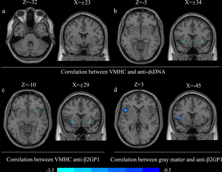 Altered structural and functional homotopic connectivity associated with cognitive changes in SLE.