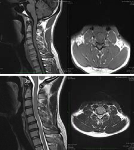 Hirayama Disease in a Young Male: A Case Report.