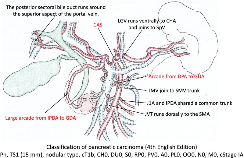Comment on "Celiac Axis Stenosis Is an Underestimated Risk Factor for Increased Morbidity After Pancreatoduodenectomy".