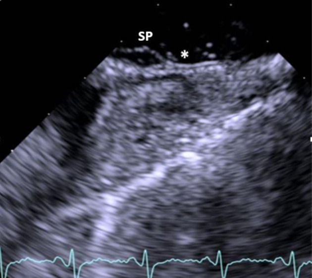 Transcatheter Closure of a Patent Foramen Ovale With a Small Adjacent Atrial Septal Defect and a Double Interatrial Septum Post Cryptogenic Stroke.