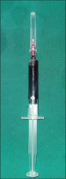 Evaluation of the serum levels of endothelin-1 and lipid profile in chronic periodontitis patients, before and after periodontal therapy.