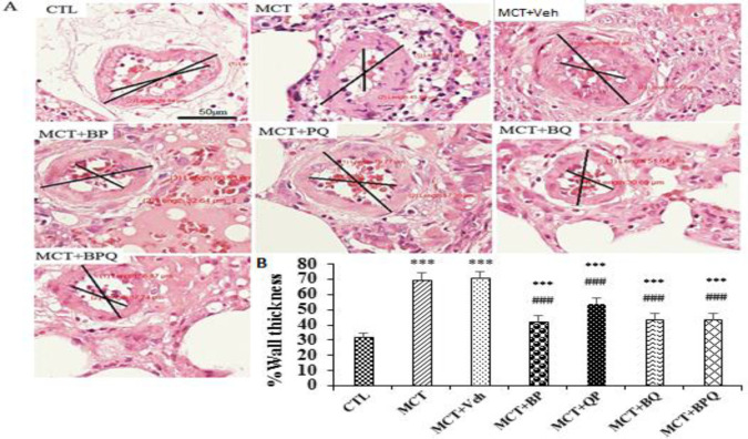 Perillyl alcohol, quercetin, and berberine combination therapy ameliorates experimental pulmonary arterial hypertension: Effects on the lung miR-204 expression, remodeling, and inflammatory factors.