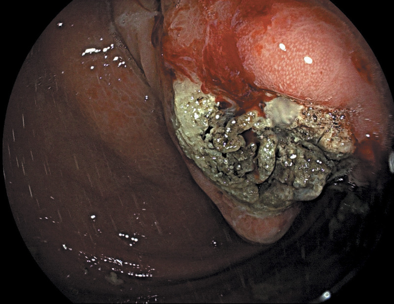 EUS-guided cyanoacrylate glue injection for the management of refractory bleeding from postglue ulcer following gastric varices treatment (with video).