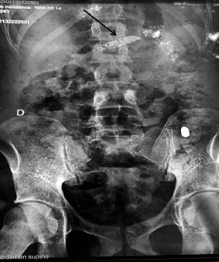 [Abdominal parietal abscess secondary to the absorption of a knife by a mental patient, Treichville University Hospital, Côte d'Ivoire].