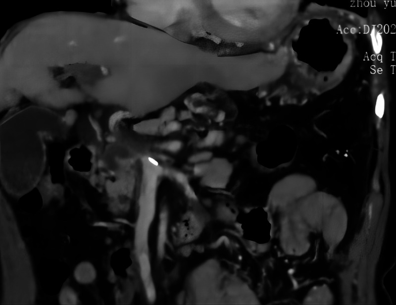 EUS-guided cyanoacrylate glue injection for the management of refractory bleeding from postglue ulcer following gastric varices treatment (with video).