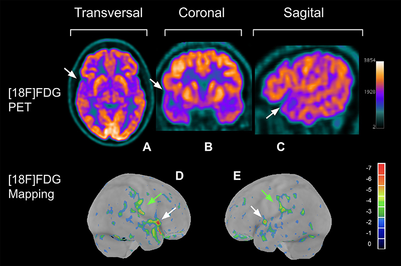 Changes in cerebral glucose metabolism among mild long COVID patients: an [18F]FDG PET/CT study.