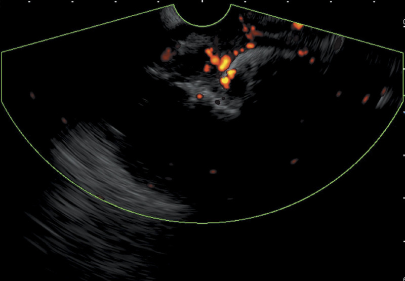 EUS-guided cyanoacrylate glue injection for the management of refractory bleeding from postglue ulcer following gastric varices treatment (with video).