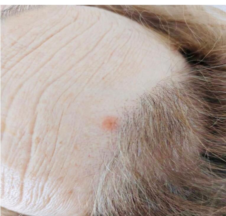 Scalp Lesion as the First Manifestation of Pancreatic Adenocarcinoma, A Very Rare Case.