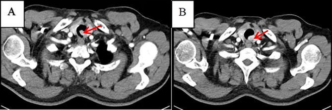 Ectopic thyroid carcinoma in central airway with normally located goiterous thyroid gland: A case report.