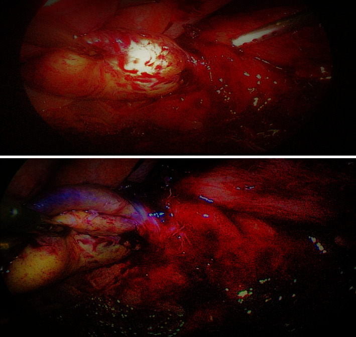 Laparoscopic Cholecystectomy for Gall Bladder Volvulus: A Report of an Original Case With Review of Literature.