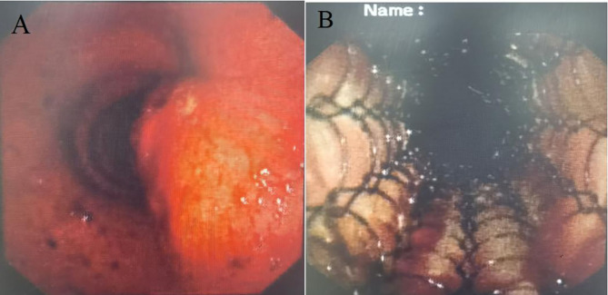 Ectopic thyroid carcinoma in central airway with normally located goiterous thyroid gland: A case report.