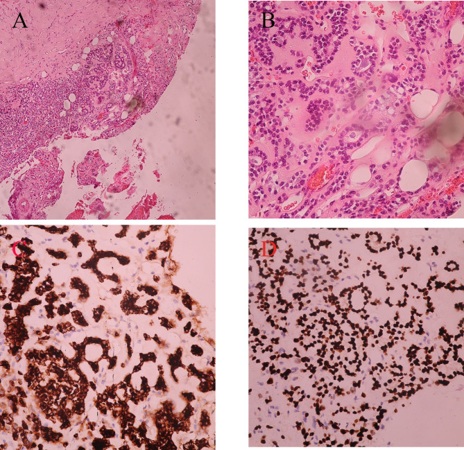 Ectopic thyroid carcinoma in central airway with normally located goiterous thyroid gland: A case report.