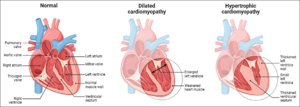 Evaluating the functional and genomic analysis of pathogenic junctophilin-2 variants and their association with the pathogenesis of cardiomyopathy to understand their molecular impact on cardiac calcium homeostasis and disease phenotypes.