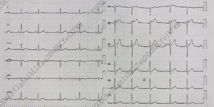 A Potential Therapeutic Effect of Suxiao Jiuxin Pills in Treating Postacute Sequelae of COVID-19: Case Report.