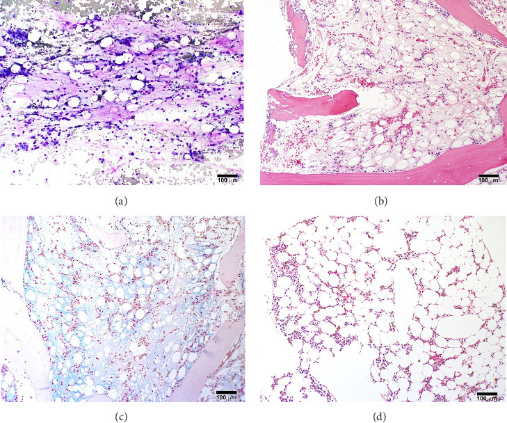 Bone Marrow Failure due to Aplastic Anemia, Associated With Serous Fat Atrophy, and Treated With Allogeneic, Haploidentical Stem Cell Transplantation: A Case Report.