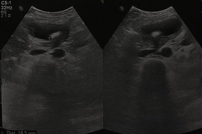 Laparoscopic Cholecystectomy for Gall Bladder Volvulus: A Report of an Original Case With Review of Literature.