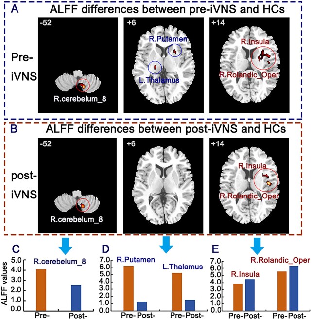 Effectiveness and possible brain mechanisms of cervical invasive vagus nerve stimulation (iVNS) intervention for avoidant/restrictive food intake disorder: a case report.