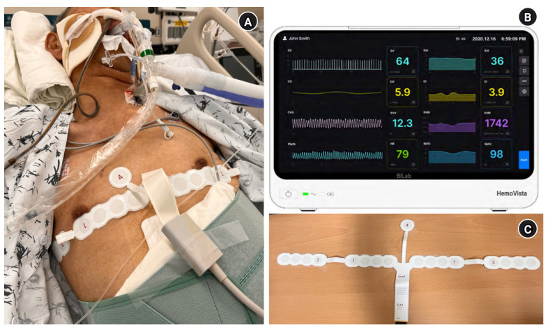 Performance evaluation of non-invasive cardiac output monitoring device (HemoVista) based on multi-channel thoracic impedance plethysmography technology.