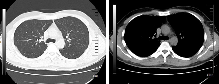 A Potential Therapeutic Effect of Suxiao Jiuxin Pills in Treating Postacute Sequelae of COVID-19: Case Report.
