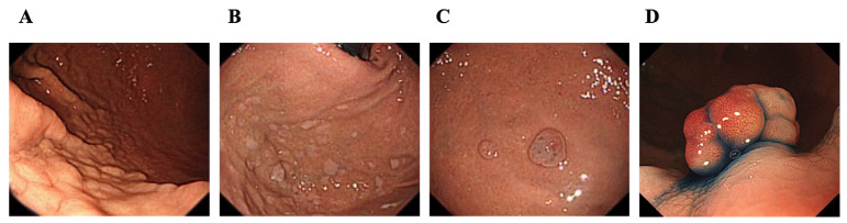 Effects of Medication Period and Gastrin Levels on Endoscopic Gastric Mucosal Changes in Long-Term Proton Pump Inhibitor Users.