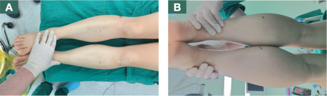 Bilateral lower extremity compartment syndrome after prolonged gynecological surgery in lithotomy position: a case report.