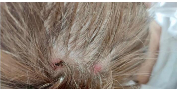 Scalp Lesion as the First Manifestation of Pancreatic Adenocarcinoma, A Very Rare Case.