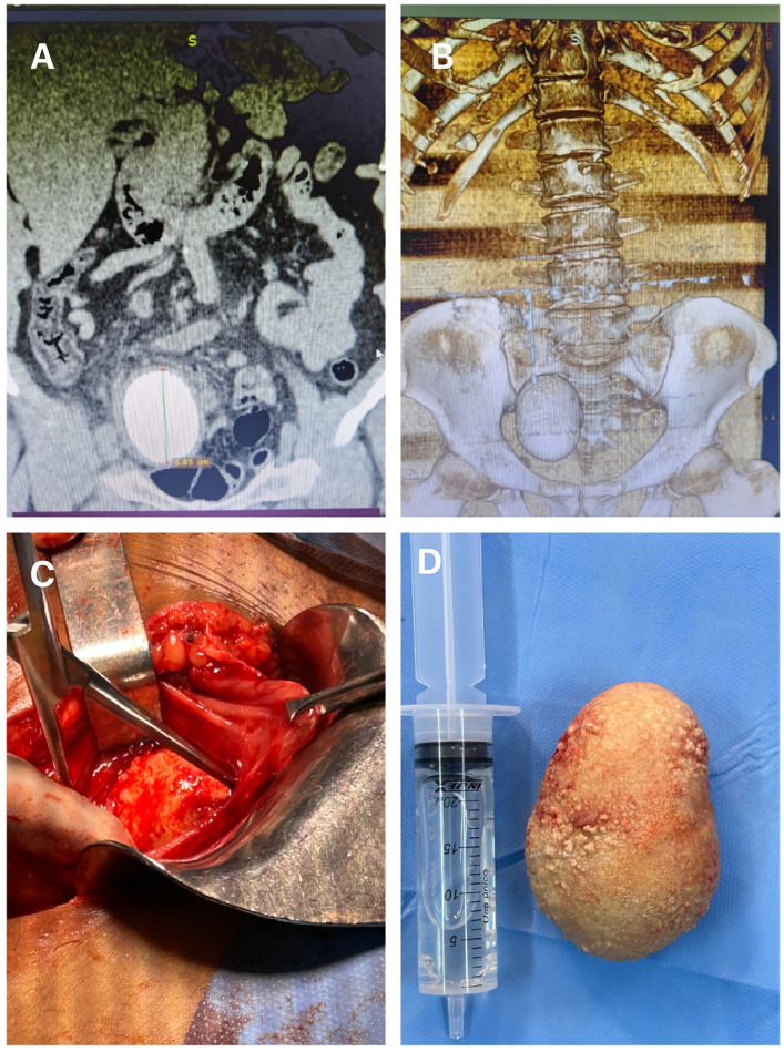 Tomographic aspect of a giant stone in a bricker urinary diversion.