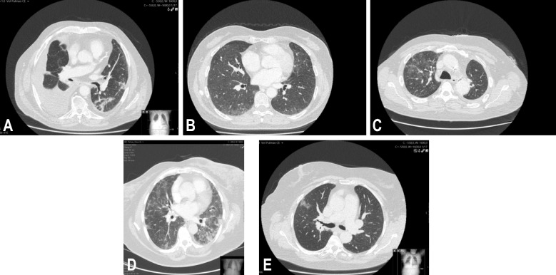Diagnosis and Management of Drug-Induced Interstitial Lung Disease in the context of Anti-Cancer Therapy: a Multidisciplinary Viewpoint by Portuguese Experts.