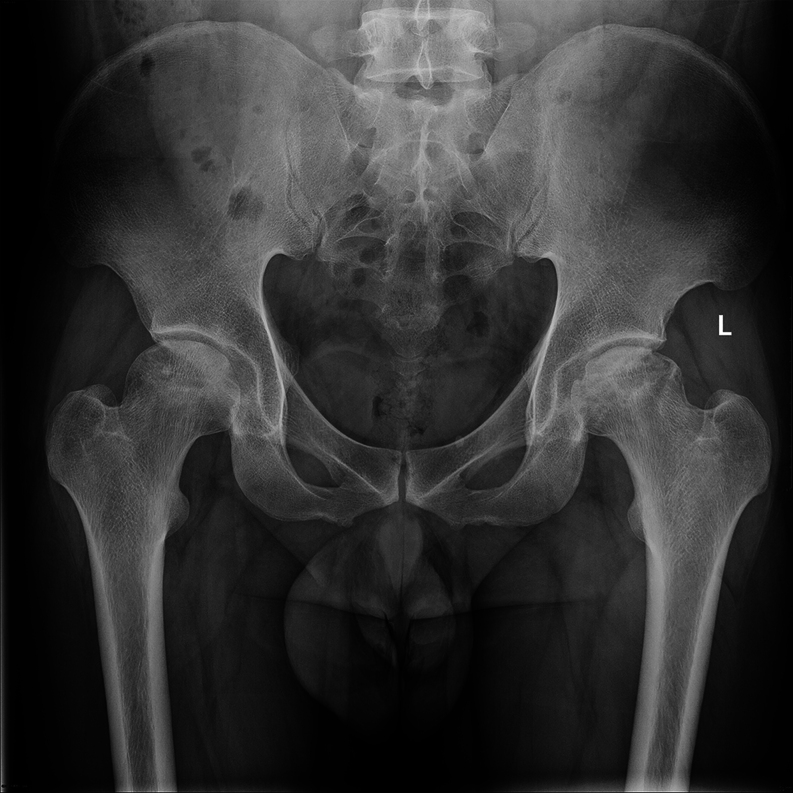 Mitochondrial maintenance as a novel target for treating steroid-induced osteonecrosis of femoral head: a narrative review.