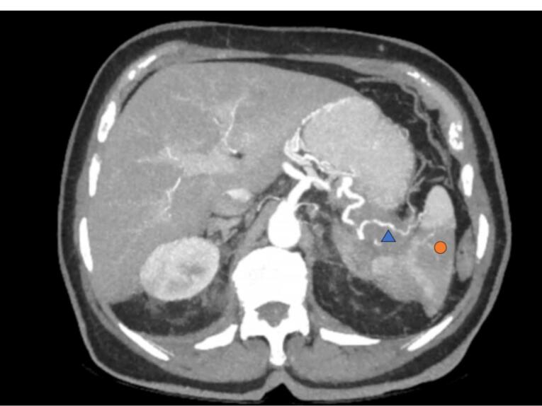 Scalp Lesion as the First Manifestation of Pancreatic Adenocarcinoma, A Very Rare Case.