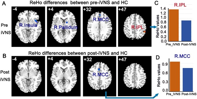 Effectiveness and possible brain mechanisms of cervical invasive vagus nerve stimulation (iVNS) intervention for avoidant/restrictive food intake disorder: a case report.