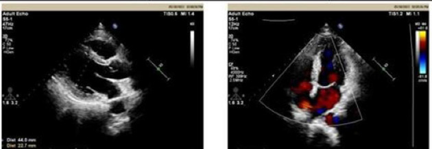 A Potential Therapeutic Effect of Suxiao Jiuxin Pills in Treating Postacute Sequelae of COVID-19: Case Report.