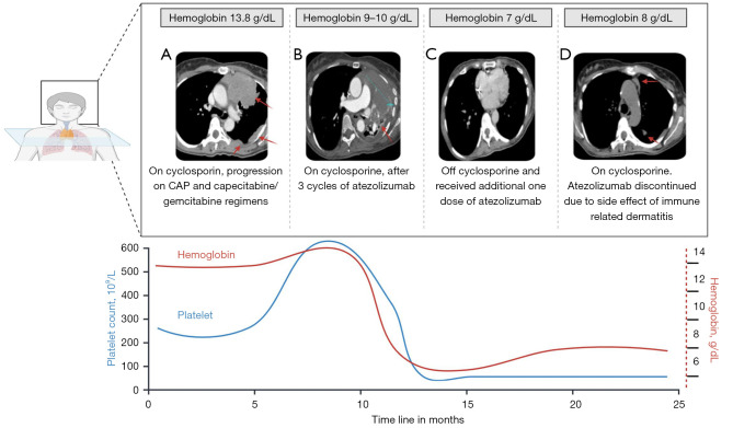 Unusual outcome of treatment of thymoma with immunotherapy: case report.