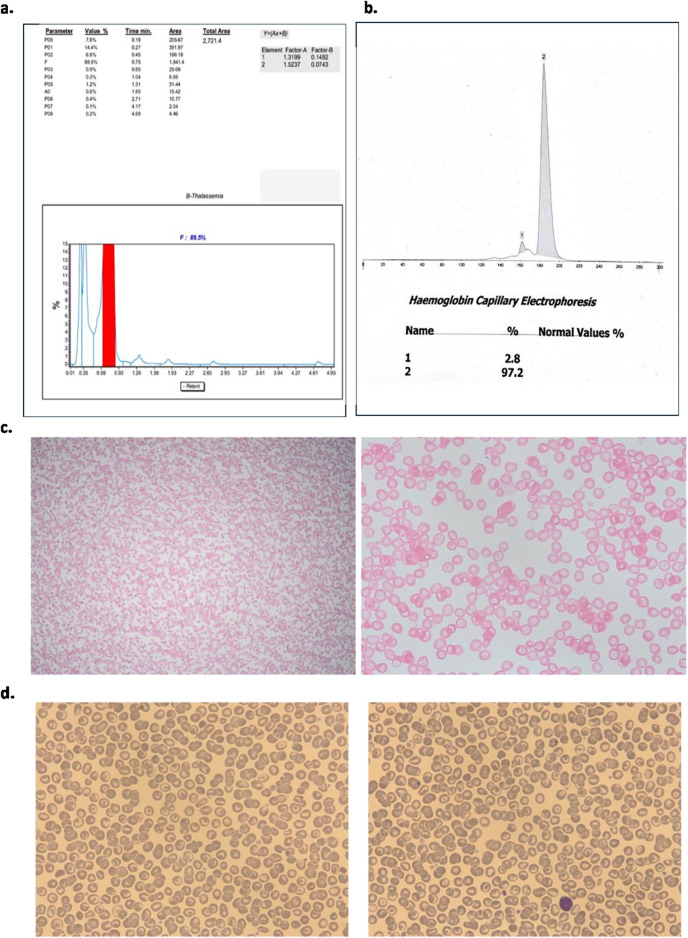 Homozygous Delta-Beta Thalassaemia With Alpha Thalassaemia and Erythrocytosis- a Rare Case Report.
