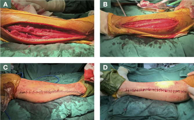 Bilateral lower extremity compartment syndrome after prolonged gynecological surgery in lithotomy position: a case report.