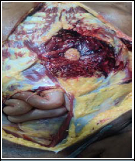 Localization of a Bullet in a Firearm Injury Victim Using X-ray Imaging During Autopsy: A Case Report.