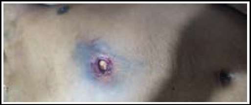 Localization of a Bullet in a Firearm Injury Victim Using X-ray Imaging During Autopsy: A Case Report.