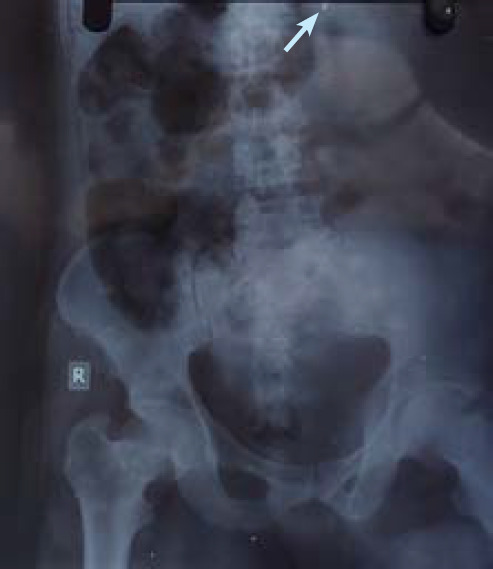 Localization of a Bullet in a Firearm Injury Victim Using X-ray Imaging During Autopsy: A Case Report.