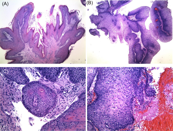 Multimodal management of PD-L1 positive sinonasal inverted papilloma with malignant transformation.