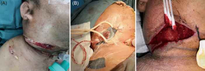 Comparing vacuum-assisted closure against conventional approach in severe deep neck infection: A retrospective case-control study.