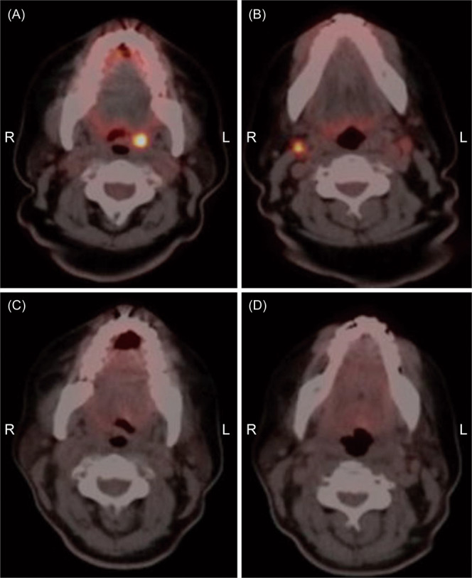 Multimodal management of PD-L1 positive sinonasal inverted papilloma with malignant transformation.