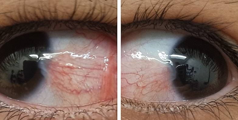 Bilateral Pterygium in a Paediatric Cancer Patient Taking Vemurafenib: A Case Report.