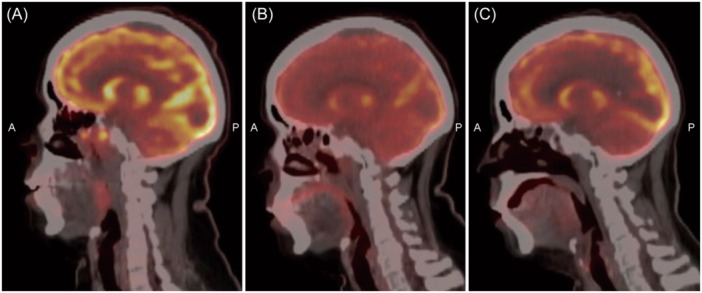 Multimodal management of PD-L1 positive sinonasal inverted papilloma with malignant transformation.