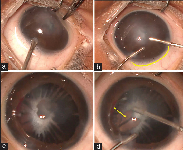 Pediatric cataract surgery in congenital anterior segment dysmorphology: An overview.