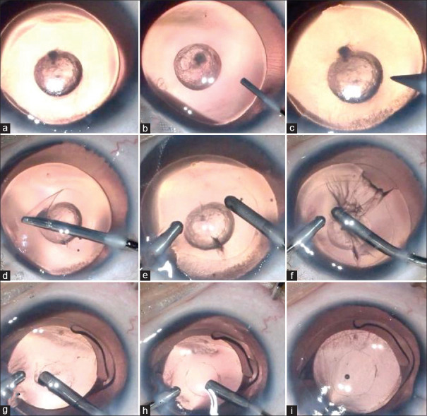 Pediatric cataract surgery in congenital anterior segment dysmorphology: An overview.